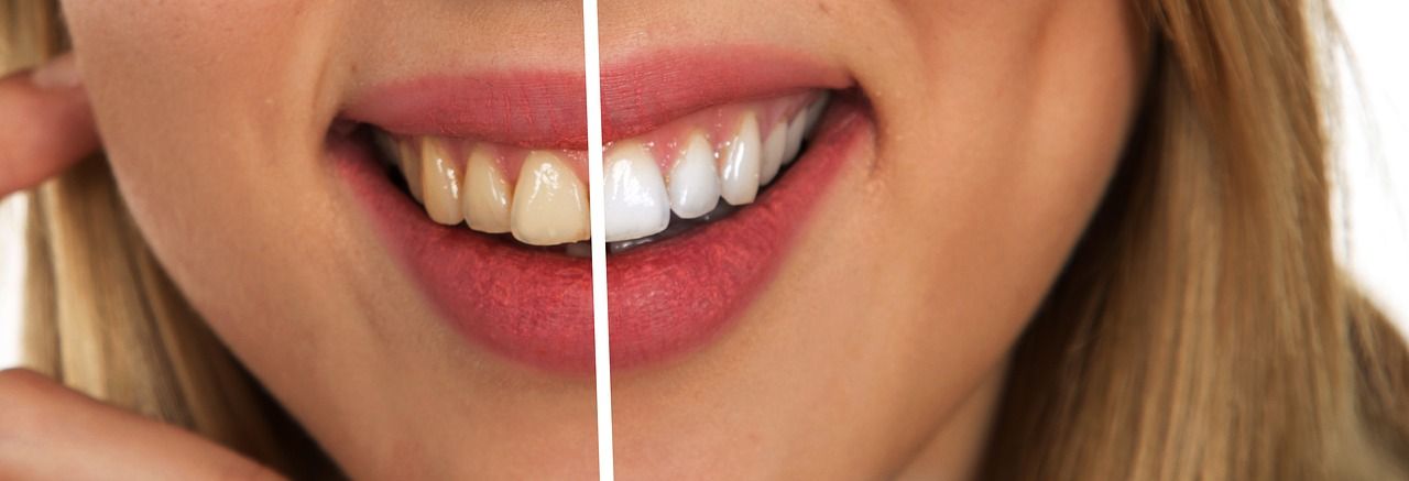 How Can I Make My Yellow Teeth Whiter Naturally?